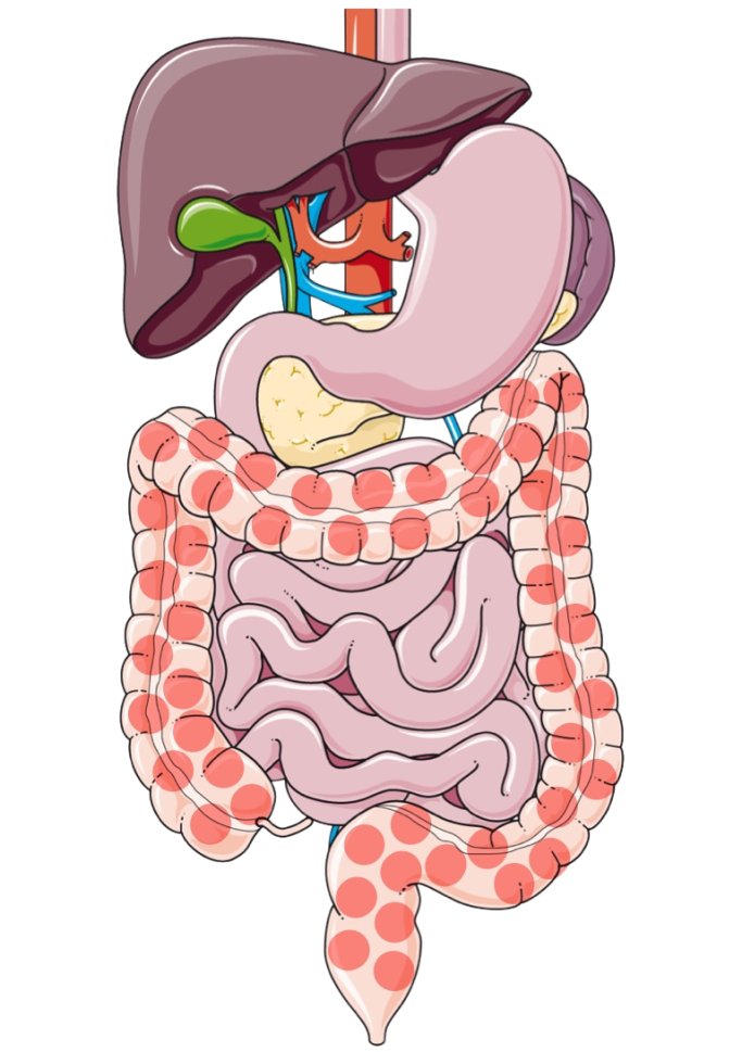 Colitis ulcerosa Schematische Darstellung des Verdauungstraktes bei Colitis ulcerosa. Hervorgehoben wird der Dickdarm als betroffener Bereich.