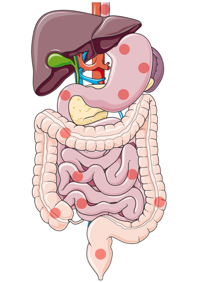 Morbus Crohn Schematische Darstellung des Verdauungstraktes bei Morbus Crohn mit einzelnen Markierungen verteilt im gesamten Verdauungstrakt.